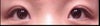 missing double eyelid
