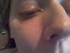 medium sized bump on the inside corner of my left eye