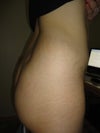 butt lift candidate?