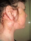 lump after facelift