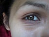 Dennie-morgan folds under eyes