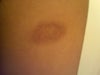 Iron Burn Scar
