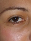scar after blepharoplasty