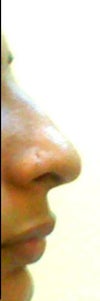 protruding upper lip