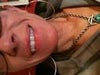 Asymmetrical Upper Lip