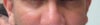 male cheek dents