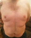 Tummy Tuck for competitive athletes