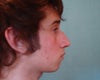 want to get a rhinoplasty because my profile is really not harmanious