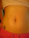 worried about stretch marks