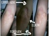 My big ugly elbow scar