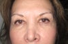 After Juvederm filler