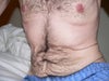 male abdominoplasty