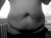 Pre op 1 day before surgery