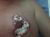 pic of my nipple. were it has burst away.it has cream on 6 weeks post op.