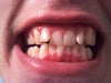 My teeth as of now.