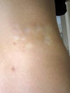 after Laser Lipolysis