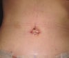 2 weeks after tummy tuck... still an outie and not happy.