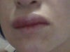 bad lip
