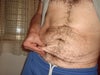 male tummy tuck vs. mini tuck