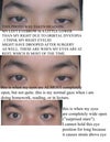 Detailed photo with 3 gazes. (This will help people with the same problem! So they are encouraged to see a surgeon about the problem.)