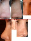 Rhinoplasty Swelling