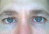 darkness near ethmoid region of inner eyes