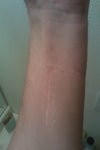 arm scar