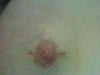 The incision 3 weeks after.  It still looks bad at 5 months after.