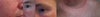 1 & 2) bumps that weeped
3 & 4) areas around eyes and neck that no longer get tan