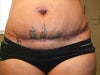 Front view of scar