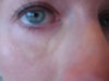 swelling sacks 4 days post restylane