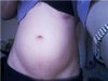 bloating and stretch marks 8 mths after 3 rd child