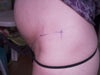 side view of my bloated tummy and pen markings from os of scar placement