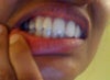 My right side bite today.