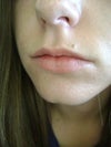 make my philtrum look normal
