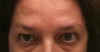 Picture take today.  Droopy eyes. 