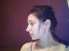 Rhinoplasty shorter tip