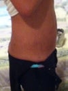 1 week post op 