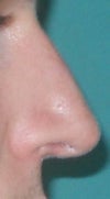Right profile not smiling.  Droops much  worse when smiling.  Can send more pics.
