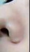 Alar base reduction scar