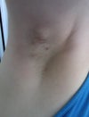 ingrown armpit hair infection
