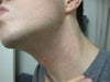 After peel. Neck very embarrassing. 