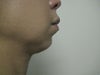 before surgery
