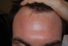 Uneven skin tone, pigment discoloration