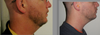 Left: day before lipo
Right: 8 months later