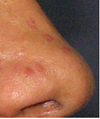 hyfercation on nose. still reddish