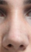 one month after rhinoplasty