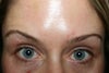 uneven brow after botox