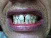 This is current smile with bonding.
Before veneers