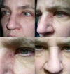 10+ weeks after Mohs.
